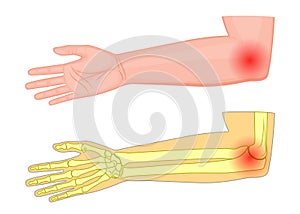 Elbow joint pain_Medial view