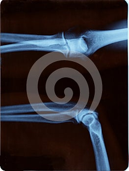 Elbow radiography photo