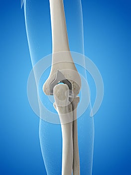 An elbow replacement