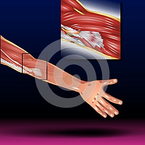 Elbow Tendonitis, Elbow Dislocation, Elbow Bone Illustration, Pain, Forearm, Cramp, Illustration, Bone, Ache