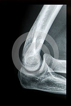 Elbow X-ray photo