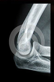 Elbow X-ray