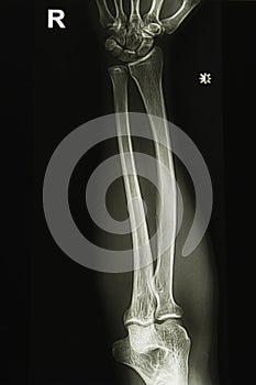 Elbow x-ray image