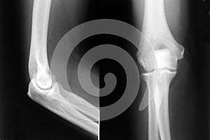 Elbow xray