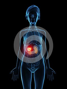 an elder females kidneys tumor