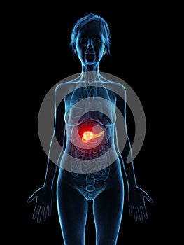 an elder females pancreas tumor