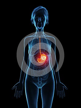 an elder females stomach tumor