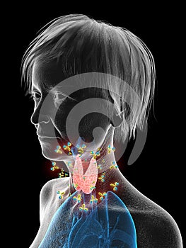 An elder females thyroid being attacked by antibodies