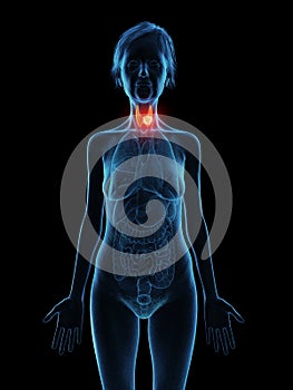 an elder females thyroid gland tumor