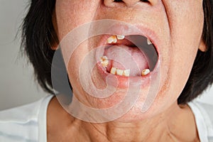 The elderly Asian woman smiled and saw the teeth remaining in the mouth.