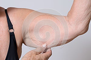Elderly lady displaying the loose skin on her arm