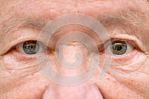 Elderly man suffering from anisocoria showing unequal pupils