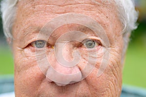 Elderly man suffering from anisocoria showing unequal pupils