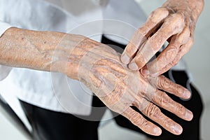 Elderly people scratching hand,itchy dry skin problem,poor circulation,reduced blood flow to the skin,cause dryness and itching,