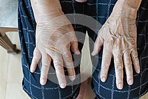 Elderly swollen hand or edema hand