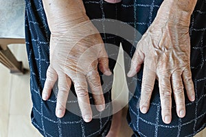 Elderly swollen hand or edema hand photo