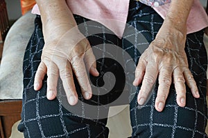 Elderly swollen hand or edema hand photo