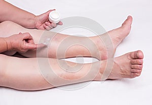 Elderly woman applies healing ointment on legs with thrombosis and varicose veins, white background, phlebeurysm thrombophlebitis