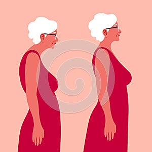 An elderly woman with a bad posture. Spine. Profile. Kyphosis.