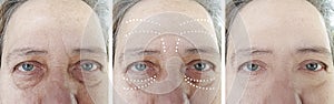 Elderly woman face wrinkles removal rejuvenationbefore and after cosmetology procedures