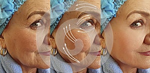 Elderly woman face wrinkles before  after treatment
