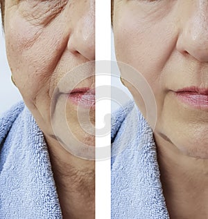 Elderly woman facial wrinkles results correction before and after cosmetology procedures