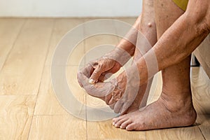 Elderly woman massage her foot with painful swollen gout inflammation photo