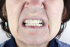 Elderly woman with new ceramic dentures