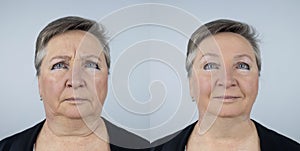 An elderly woman at the reception of a facial plastic surgeon. Consultation on the removal of age wrinkles on the face. The doctor