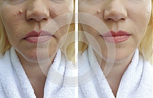 Elderly woman`s face wrinkles lifting collagen dermatology regeneration treatment therapy before and after procedures