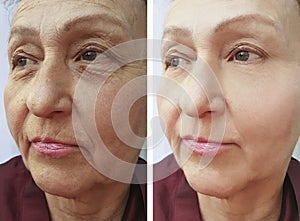 Elderly woman`s face wrinkles before and after procedures