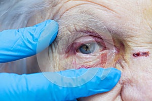 Elderly woman`s injured eye & nurse`s fingers