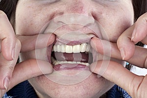 Elderly woman shows the new ceramic dentures