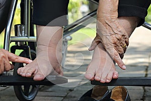 Elderly woman swollen feet press test on wheelchair