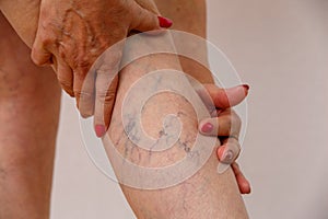 An elderly woman in white panties is touching her legs with cellulite and varicose veins on a light isolated background.