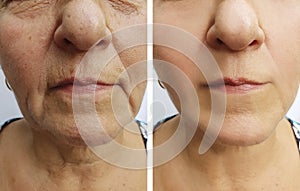 Elderly woman wrinkles face before and after health treatment cosmetology correction procedure