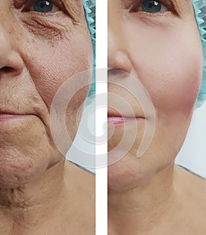 Elderly woman wrinkles on face medical lifting regeneration before after