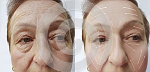 Elderly woman wrinkles on face before and after procedures