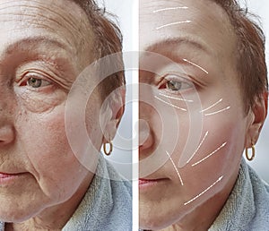 Elderly woman wrinkles on face therapy results cosmetology before and after procedures