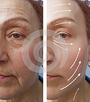 Elderly Woman wrinkles before after medicine contour tension hydrating the procedure effect regeneration