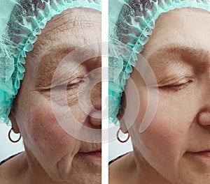 Elderly woman wrinkles removal dermatology correction face before and after procedures, effect