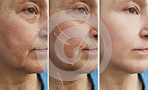Elderly woman wrinkles removal before and after lift difference