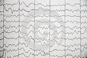 Electrical activity of the brain, EEG of pediatric patients with immaturity of the cerebral cortex
