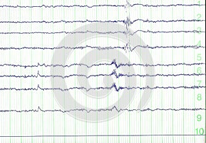 Electro-encephalogramme