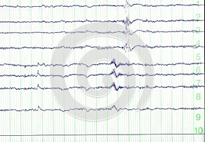 Electro-encephalogramme