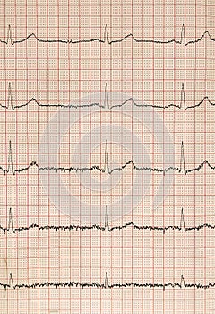 Electro-encephalogramme