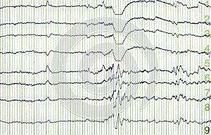 Electro-encephalogramme img