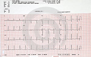 Electrocardiogram photo