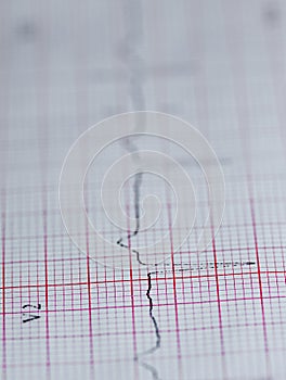 Electrocardiogram