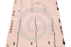 Electrocardiogram